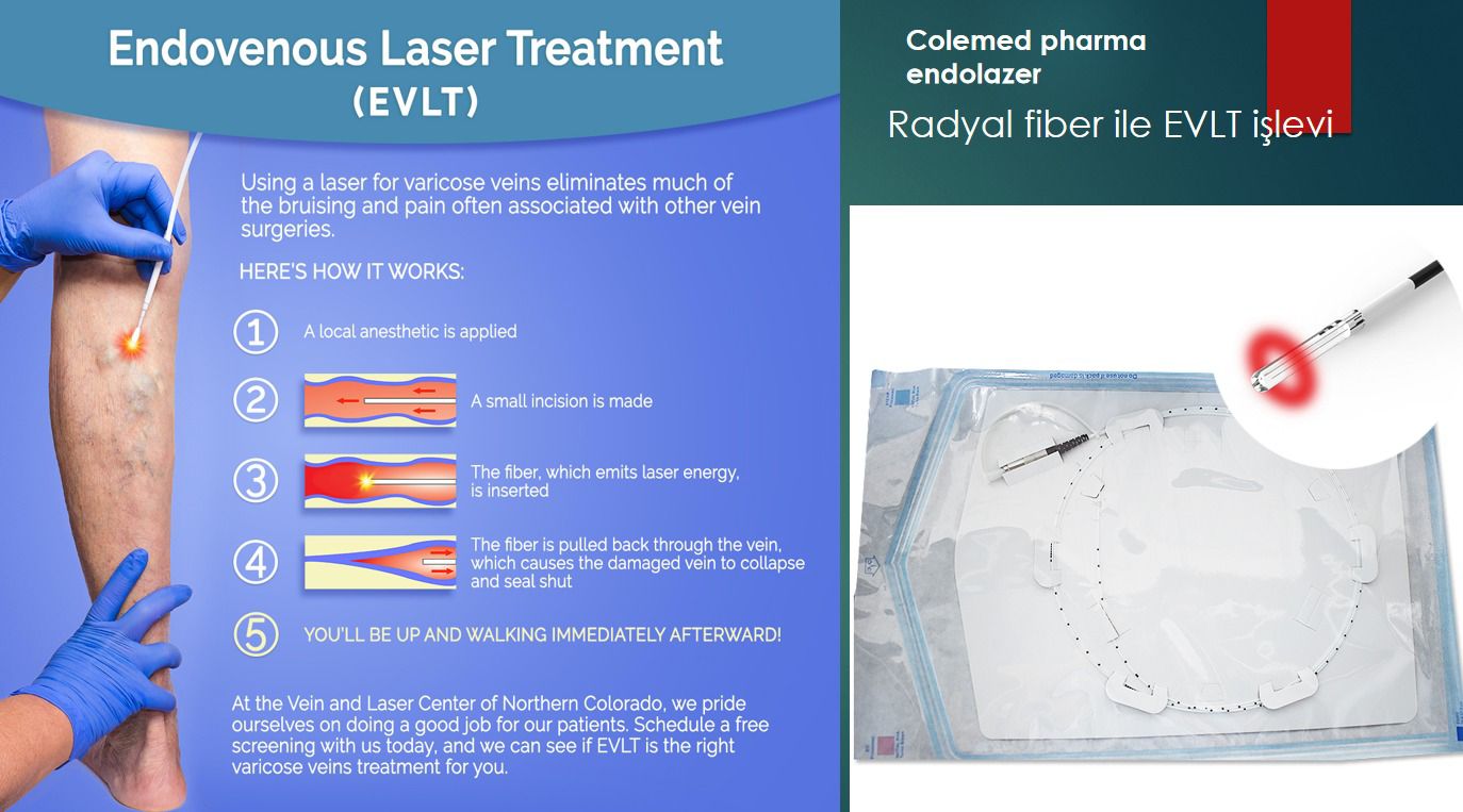 EVLT Radyal fiber