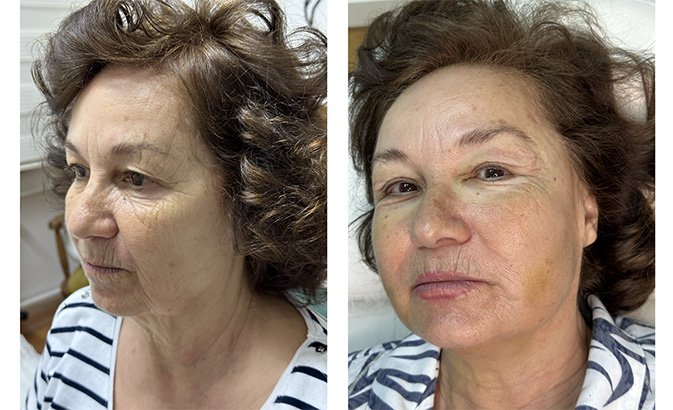 Endolift nedir kimler için uygundur?